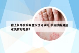 臉上長(zhǎng)牛皮癬用鹽水洗可以嗎 牛皮膚癬用鹽水洗有好處嘛?