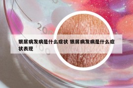 銀屑病發(fā)病是什么癥狀 銀屑病發(fā)病是什么癥狀表現(xiàn)
