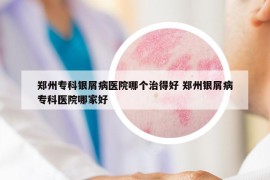 鄭州?？沏y屑病醫(yī)院哪個治得好 鄭州銀屑病?？漆t(yī)院哪家好