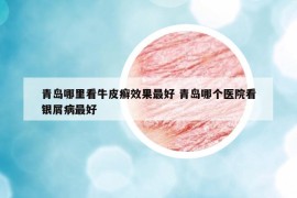 青島哪里看牛皮癬效果最好 青島哪個醫(yī)院看銀屑病最好