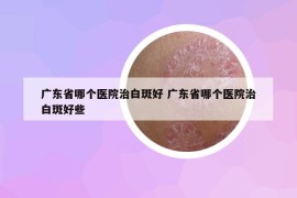 廣東省哪個醫(yī)院治白斑好 廣東省哪個醫(yī)院治白斑好些