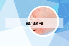 趙霖牛皮癬療法