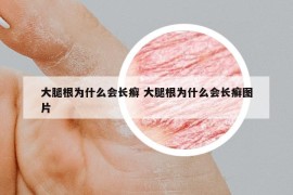 大腿根為什么會長癬 大腿根為什么會長癬圖片