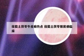 菝葜土茯苓牛皮癬熱點(diǎn) 菝葜土茯苓銀屑病臨床