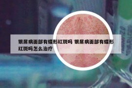 銀屑病面部有蝶形紅斑嗎 銀屑病面部有蝶形紅斑嗎怎么治療