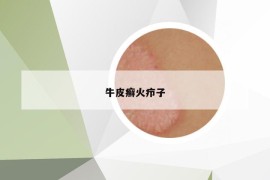 牛皮癬火癤子