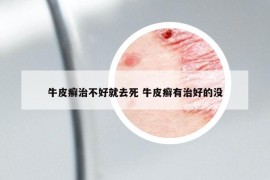 牛皮癬治不好就去死 牛皮癬有治好的沒