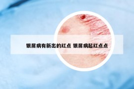 銀屑病有新出的紅點(diǎn) 銀屑病起紅點(diǎn)點(diǎn)