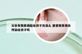 父親有銀屑病能給孩子洗澡么 爸爸銀屑病會傳染給孩子嗎