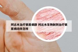 阿達(dá)木治療銀屑病群 阿達(dá)木生物制劑治療銀屑病功效怎樣