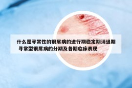 什么是尋常性的銀屑病的進(jìn)行期穩(wěn)定期消退期 尋常型銀屑病的分期及各期臨床表現(xiàn)