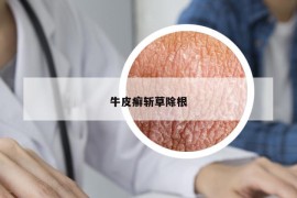牛皮癬斬草除根