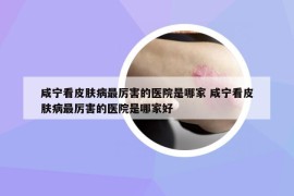 咸寧看皮膚病最厲害的醫(yī)院是哪家 咸寧看皮膚病最厲害的醫(yī)院是哪家好
