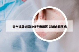 鄭州銀屑病醫(yī)院僅尋楊淑蓮 鄭州市銀屑病