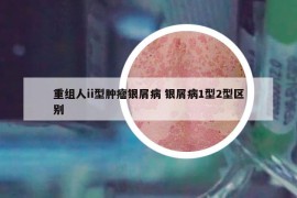 重組人ii型腫瘤銀屑病 銀屑病1型2型區(qū)別