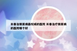 長春治銀屑病最權(quán)威的醫(yī)院 長春治療銀屑病的醫(yī)院哪個(gè)好