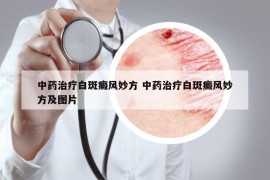 中藥治療白斑癜風妙方 中藥治療白斑癜風妙方及圖片