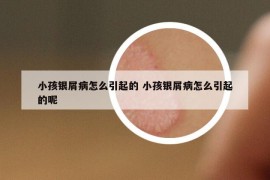 小孩銀屑病怎么引起的 小孩銀屑病怎么引起的呢