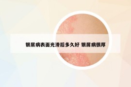 銀屑病表面光滑后多久好 銀屑病很厚