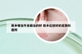 新鄉(xiāng)哪治牛皮癬治的好 新鄉(xiāng)比較好的皮膚科醫(yī)院