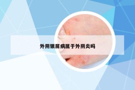 外陰銀屑病屬于外陰炎嗎