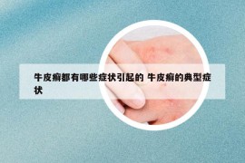牛皮癬都有哪些癥狀引起的 牛皮癬的典型癥狀
