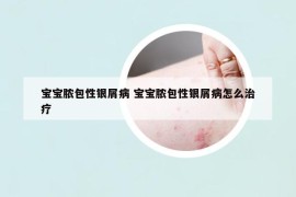 寶寶膿包性銀屑病 寶寶膿包性銀屑病怎么治療