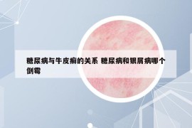 糖尿病與牛皮癬的關(guān)系 糖尿病和銀屑病哪個(gè)倒霉