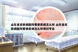 山東省皮膚病醫(yī)院看銀屑病怎么樣 山東省皮膚病醫(yī)院看銀屑病怎么樣博潤(rùn)專業(yè)