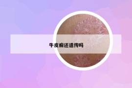 牛皮癬還遺傳嗎