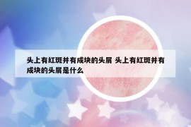 頭上有紅斑并有成塊的頭屑 頭上有紅斑并有成塊的頭屑是什么