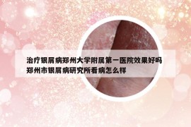 治療銀屑病鄭州大學(xué)附屬第一醫(yī)院效果好嗎 鄭州市銀屑病研究所看病怎么樣