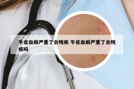 牛皮血癬嚴(yán)重了會(huì)殘疾 牛皮血癬嚴(yán)重了會(huì)殘疾嗎