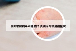 貴陽(yáng)銀屑病手術(shù)哪里好 貴州治療銀屑病醫(yī)院