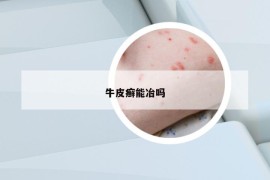 牛皮癬能冶嗎