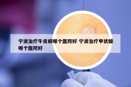 寧波治療牛皮癬哪個醫(yī)院好 寧波治療甲狀腺哪個醫(yī)院好