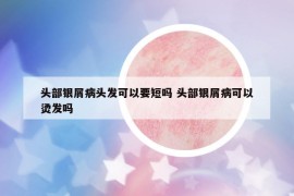 頭部銀屑病頭發(fā)可以要短嗎 頭部銀屑病可以燙發(fā)嗎