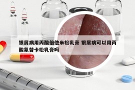 銀屑病用丙酸倍他米松乳膏 銀屑病可以用丙酸氟替卡松乳膏嗎