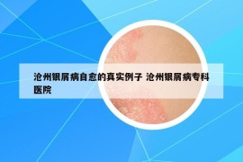 滄州銀屑病自愈的真實(shí)例子 滄州銀屑病專(zhuān)科醫(yī)院