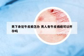 男下身犯牛皮癬怎辦 男人有牛皮病癬可以懷孕嗎