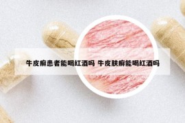 牛皮癬患者能喝紅酒嗎 牛皮膚癬能喝紅酒嗎