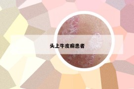 頭上牛皮癬患者