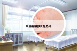 牛皮癬腰部長是熱證