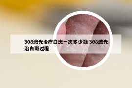 308激光治療白斑一次多少錢 308激光治白斑過程