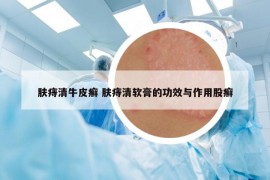 膚痔清牛皮癬 膚痔清軟膏的功效與作用股癬