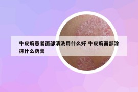 牛皮癬患者面部清洗用什么好 牛皮癬面部涂抹什么藥膏