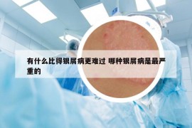 有什么比得銀屑病更難過(guò) 哪種銀屑病是最嚴(yán)重的