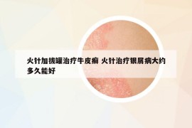 火針加拔罐治療牛皮癬 火針治療銀屑病大約多久能好