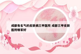 成都有名氣的皮膚病三甲醫(yī)院 成都三甲皮膚醫(yī)院哪家好