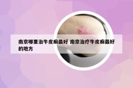 南京哪里治牛皮癬最好 南京治療牛皮癬最好的地方